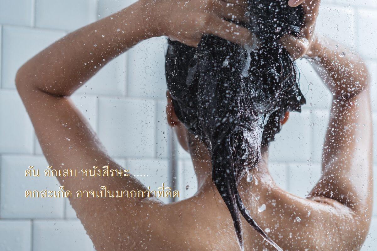 คัน อักเสบ หนังศีรษะตกสะเก็ด อาจเป็นมากกว่าที่คิด