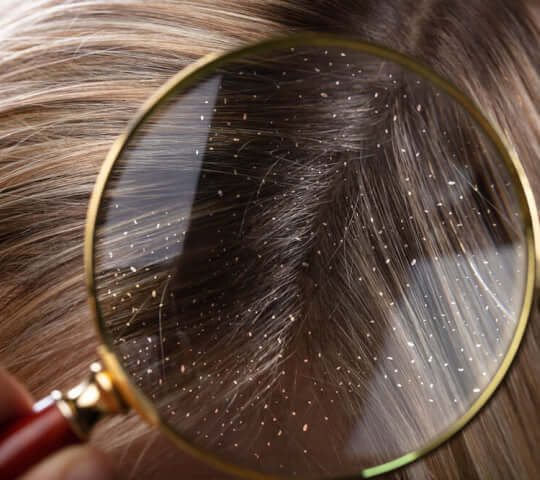 Itchy and Dry Scalp: Is It Dandruff or Just a Scaly Scalp?